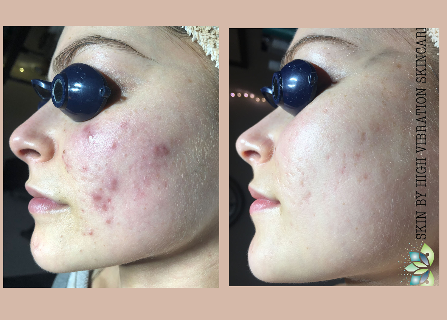 Acne Clearing + Pigment Correction (3 chemical peels ) (3)