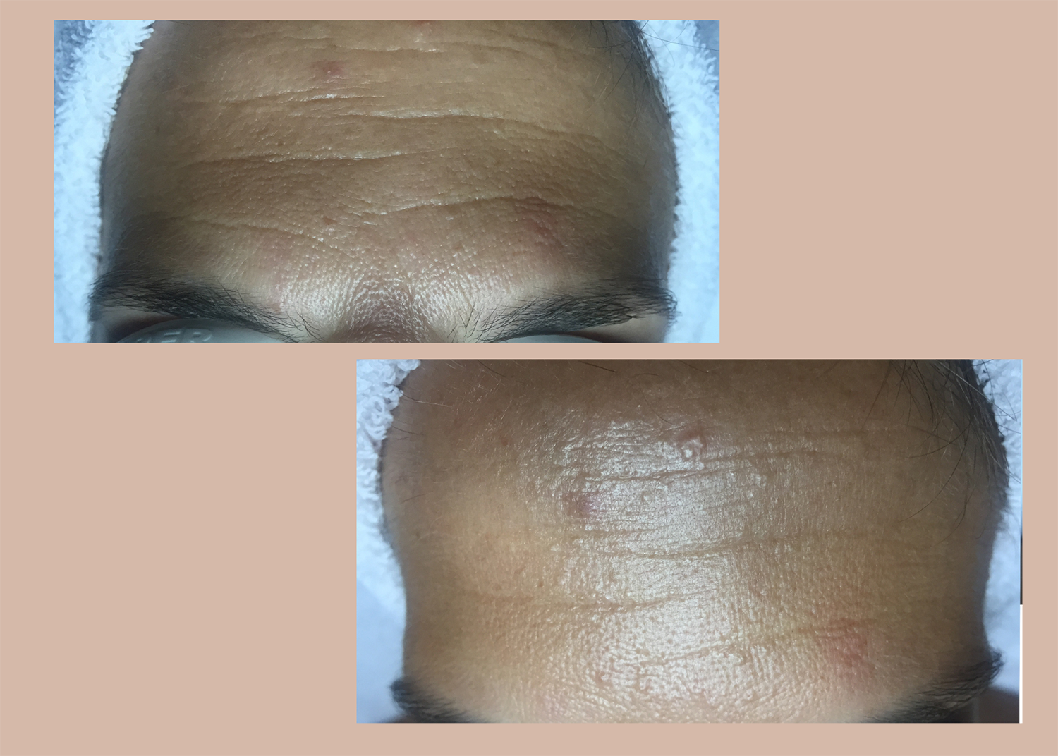 Age Defying: 1 Micro-needling