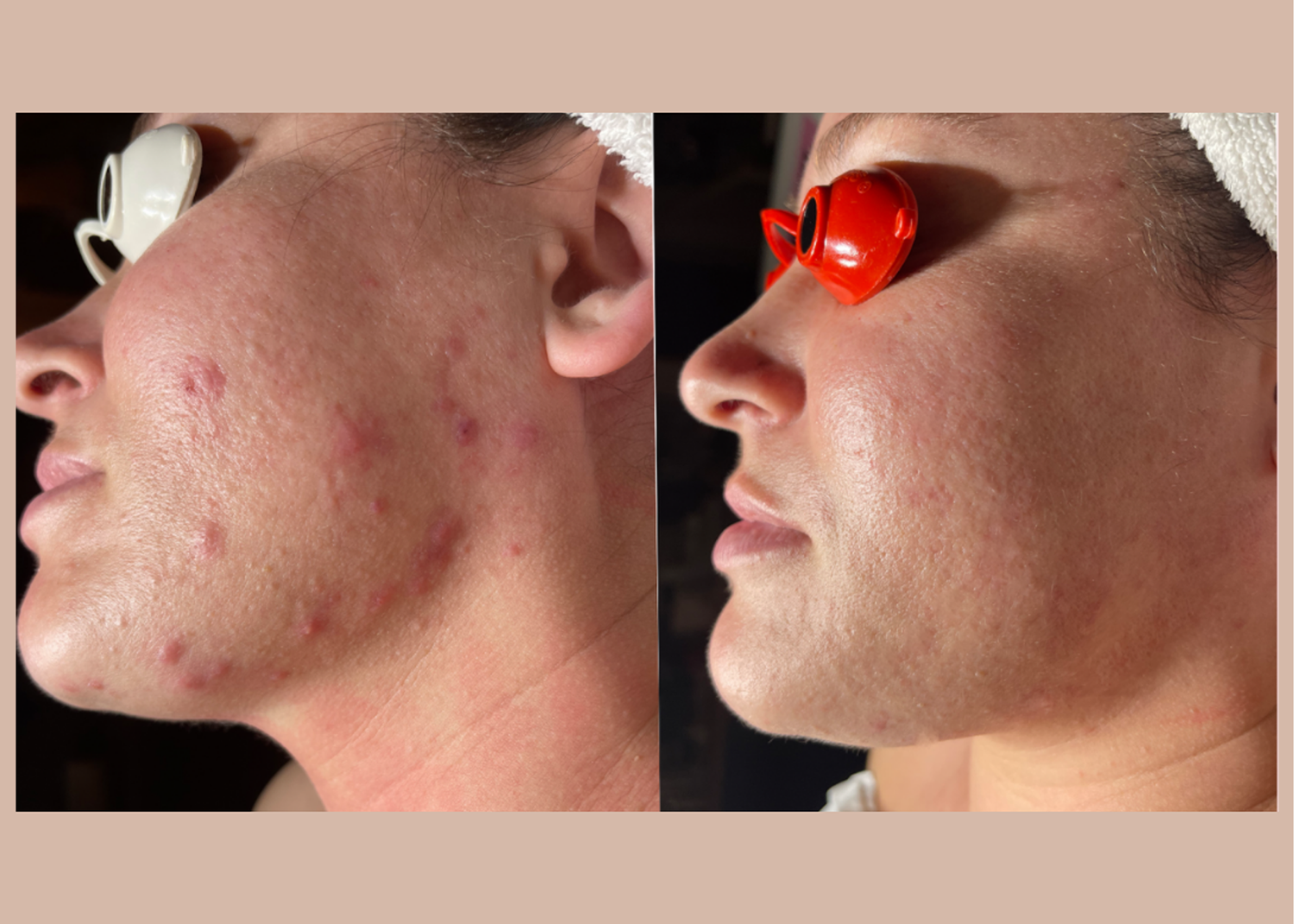 PHR Method - Beauty Bootcamp - 4 month comprehensive program- Acne Clearing (4)