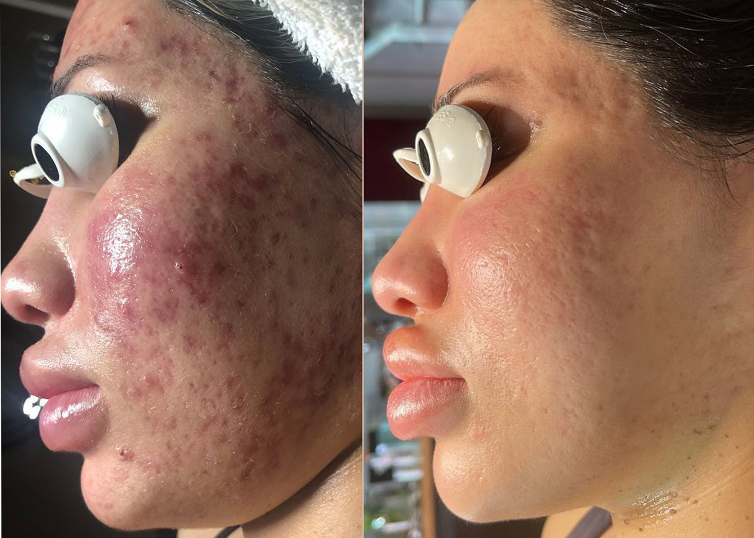 PHR Method - Beauty Bootcamp - 4 month comprehensive program - Acne Clearing + Lipid Barrier Repair (2)