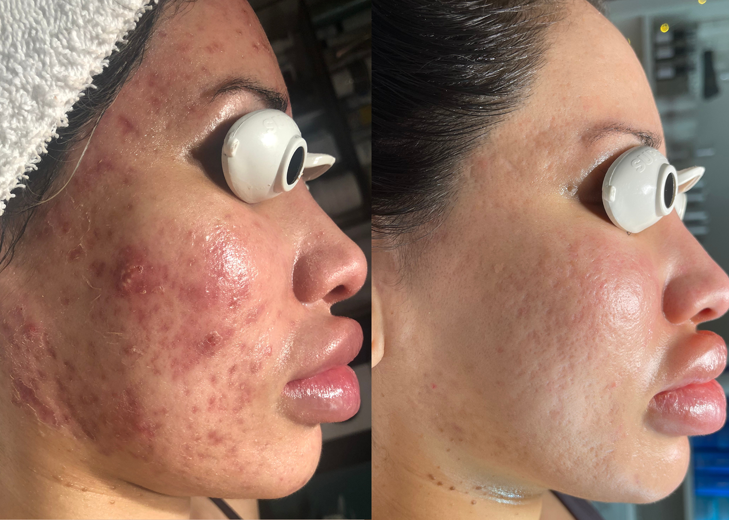 PHR Method - Beauty Bootcamp - 4 month comprehensive program - Acne Clearing + Lipid Barrier Repair