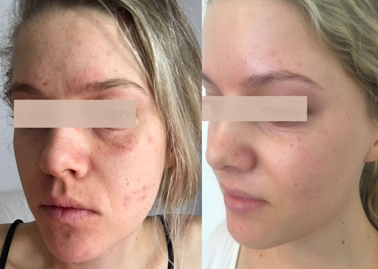 PHR Method - Beauty Bootcamp - 4 month comprehensive program - Acne Clearing + Rosacea + Lipid Barrier Repair