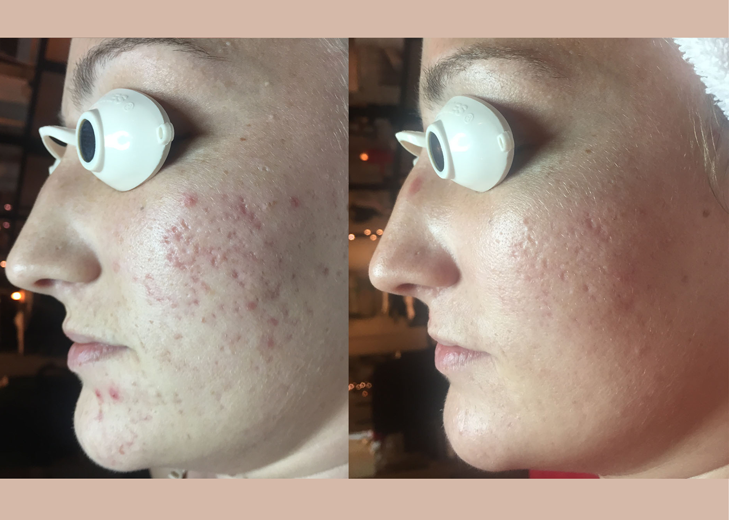 PHR Method - Beauty Bootcamp - 4 month comprehensive program- Acne Clearing + Scar Removal + Pigment Correction (11)