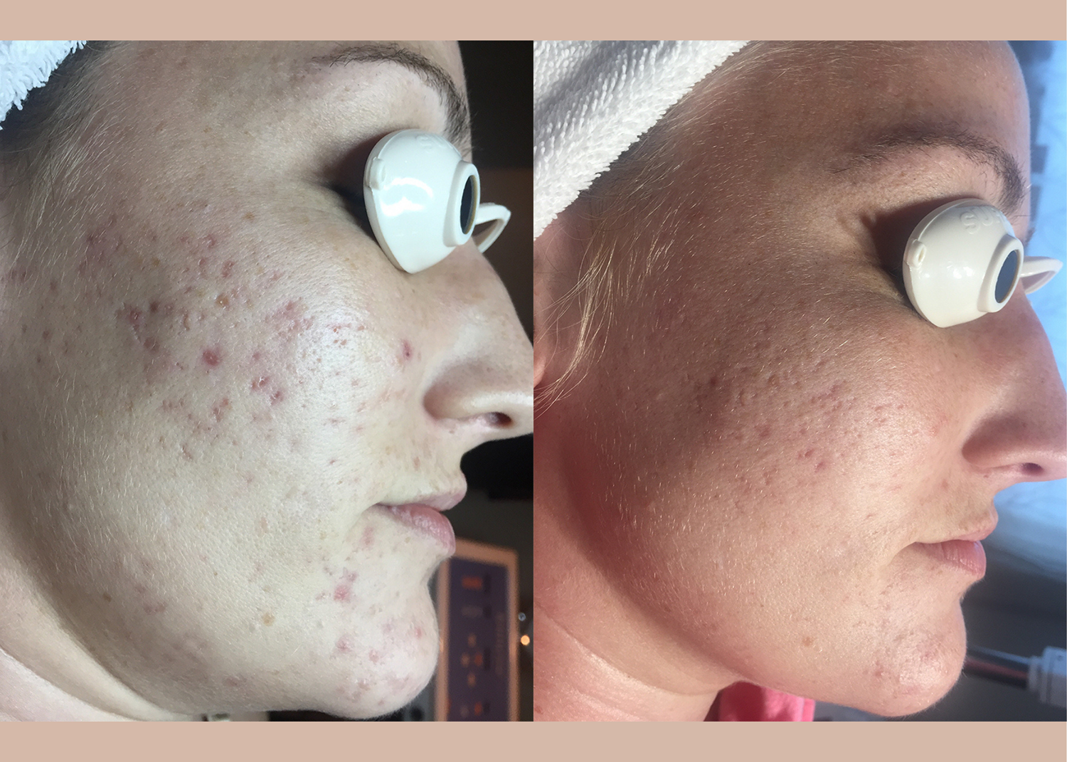 PHR Method - Beauty Bootcamp - 4 month comprehensive program- Acne Clearing + Scar Removal + Pigment Correction (12)