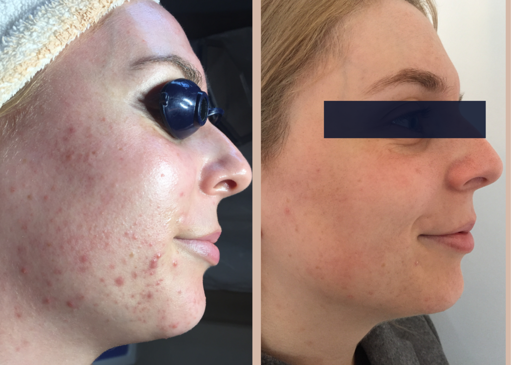 PHR Method - Beauty Bootcamp - 4 month comprehensive program- Pigment Correction + Acne Clearing (2)