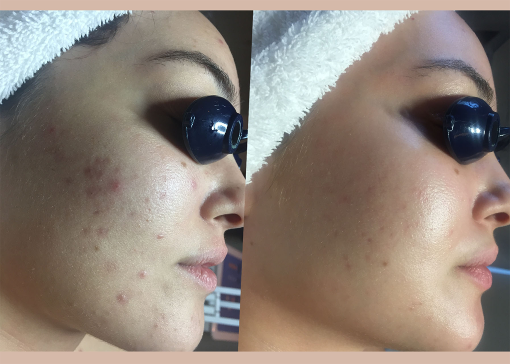 1. Acne Clearing - 1 Chemical Peel