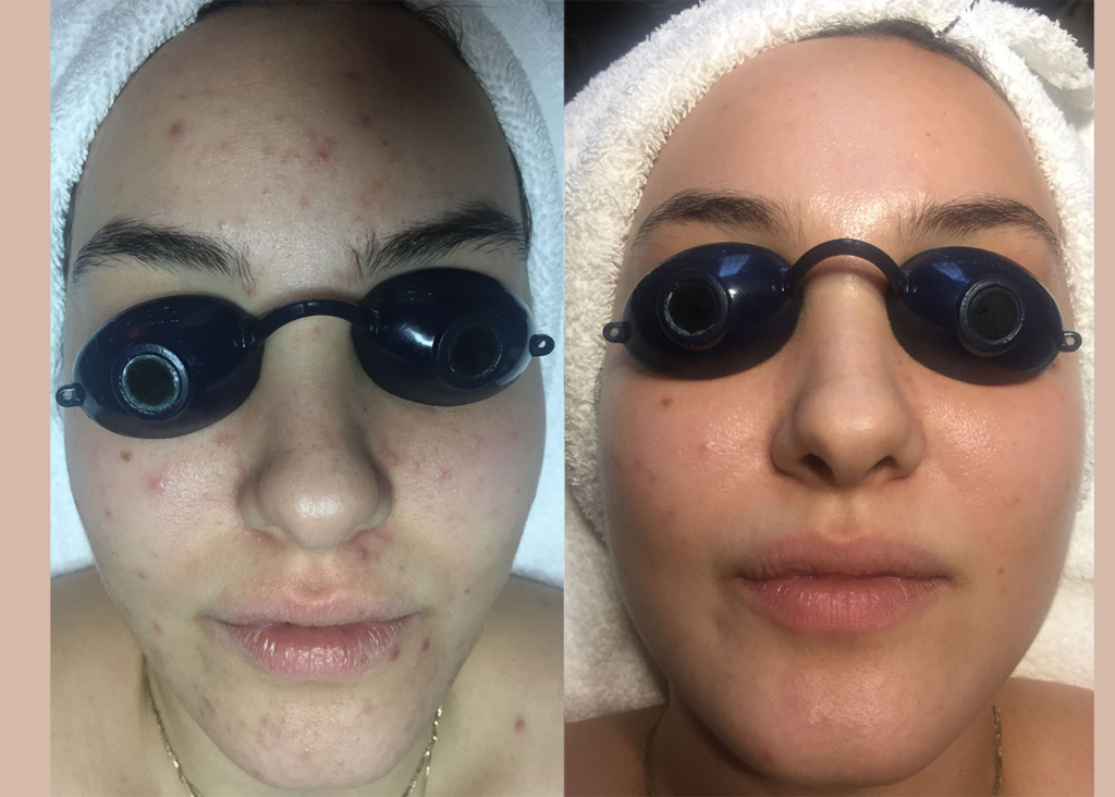 1.2 Acne Clearing + Pigment Correction - 2 Diamond Glows + 1 Chemical Peel