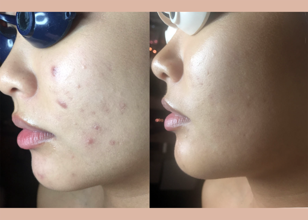 10. Acne Clearing + Pigment Correcting 1 chemical peel