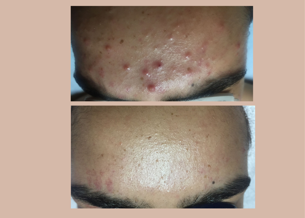 10. SBB - 4 month comprehensive program- Acne Clearing + Scar Removal + Pigment Correction (7)