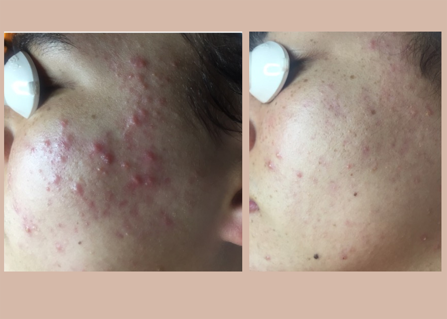 10.2 SBB- 4 month comprehensive program- Acne Clearing + Scar Removal + Pigment Correction