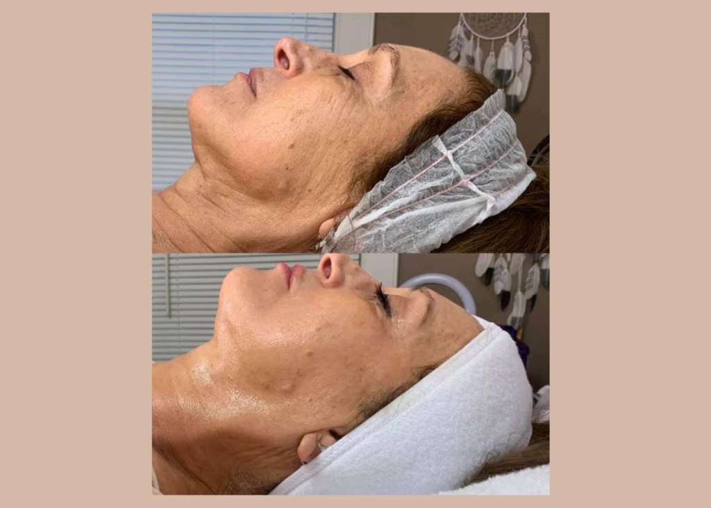 Age Repair: 3 Cryo Facials