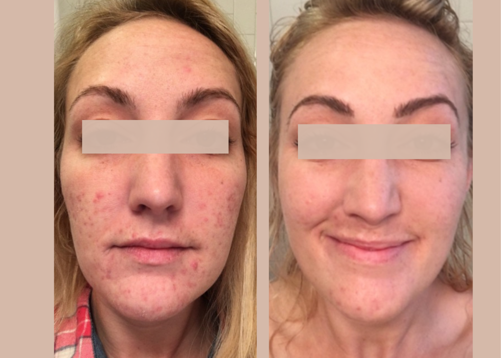 Beauty Bootcamp 4 Month Comprehensive Program: Acne Clearing + Scarring