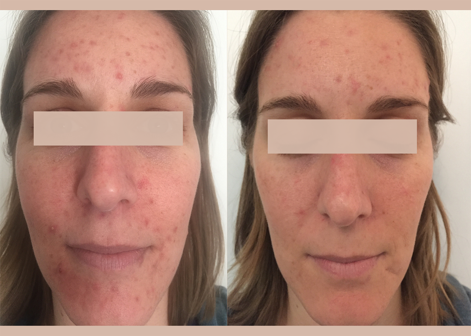 12. Acne Clearing + Pigment Correcting 1 chemical peel (2)