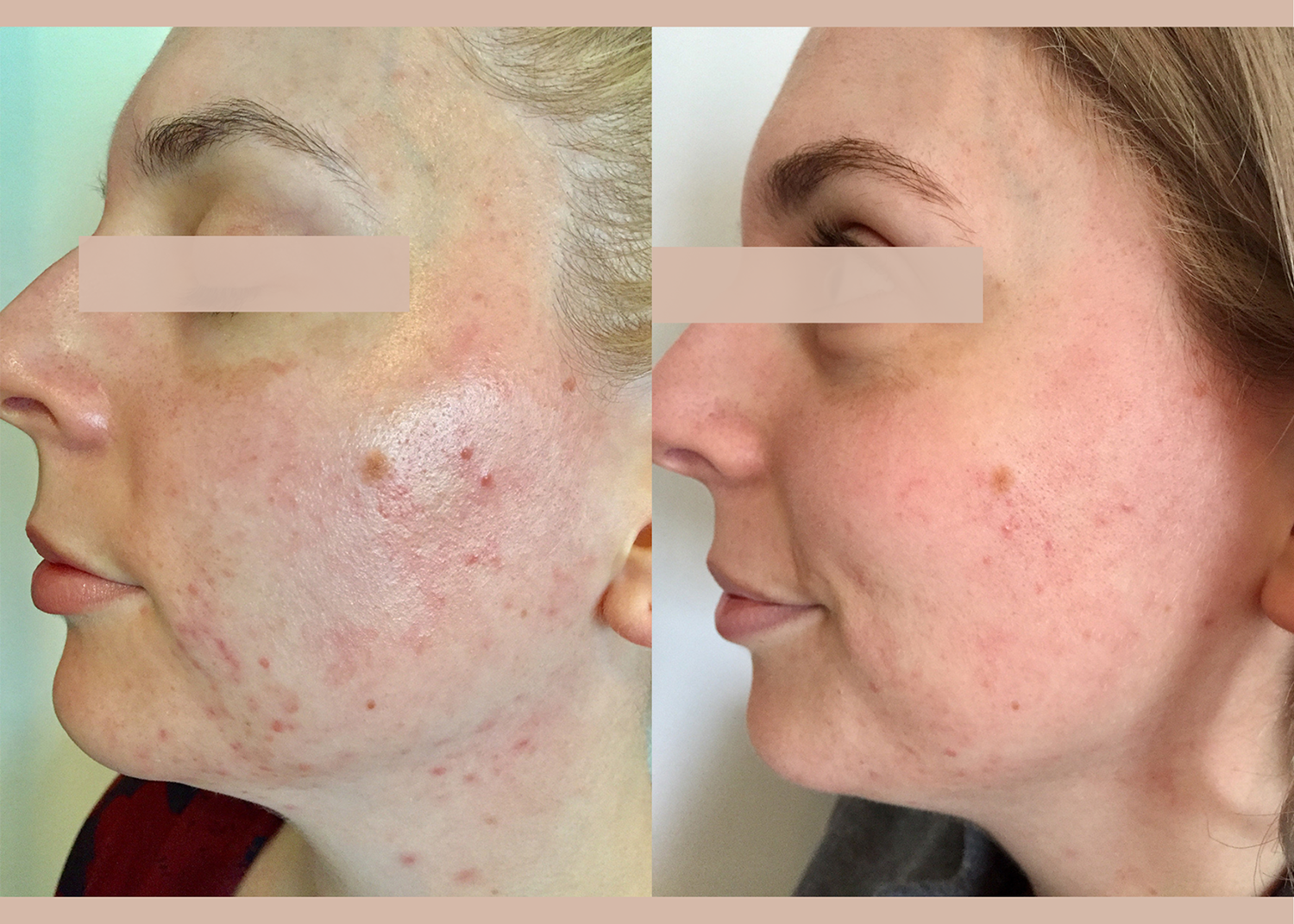 12.3 - 4 month comprehensive program- Pigment Correction + Acne Clearing (3)