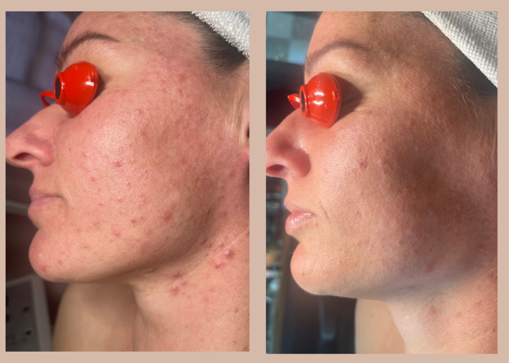 13. SBB- 4 month comprehensive program- Acne Clearing + Pigment Correction