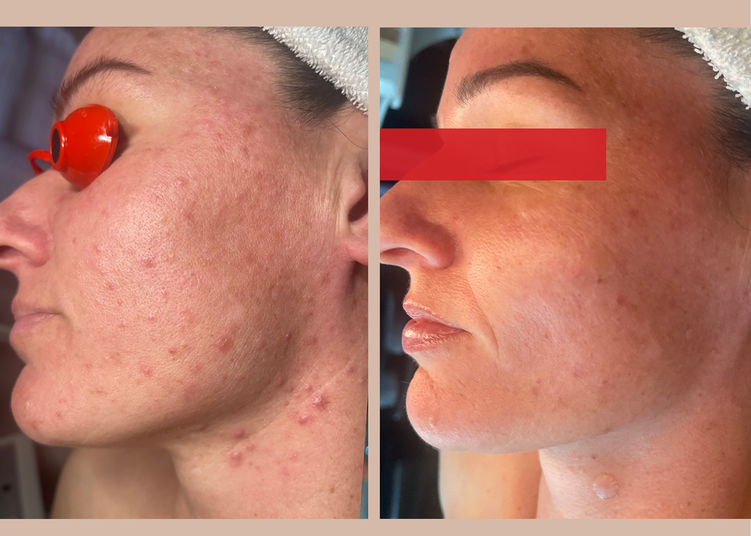 13.1 SBB - 4 month comprehensive program- Acne Clearing + Pigment Correction (13)