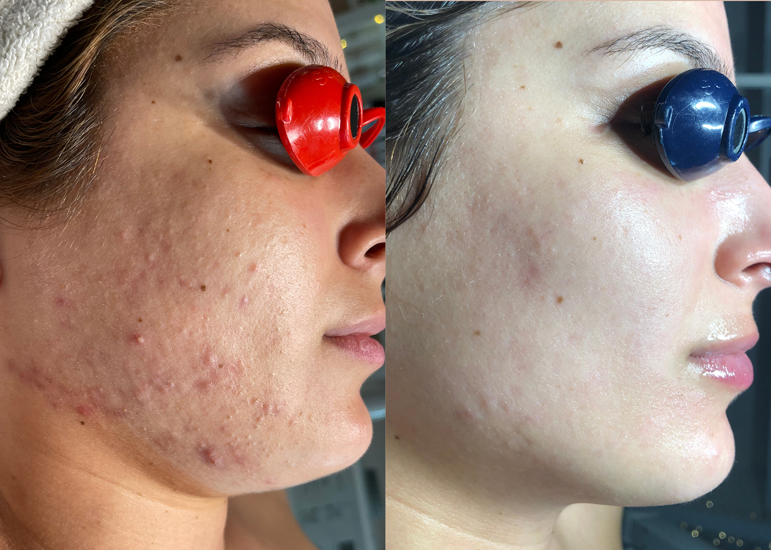 14 SBB- 4 month comprehensive program- Acne Clearing