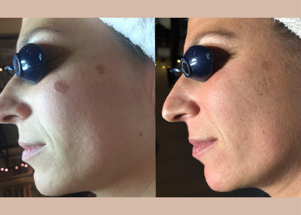 Age Repair: 2 Vegan Vampire Facials + 1 Chemical Peel