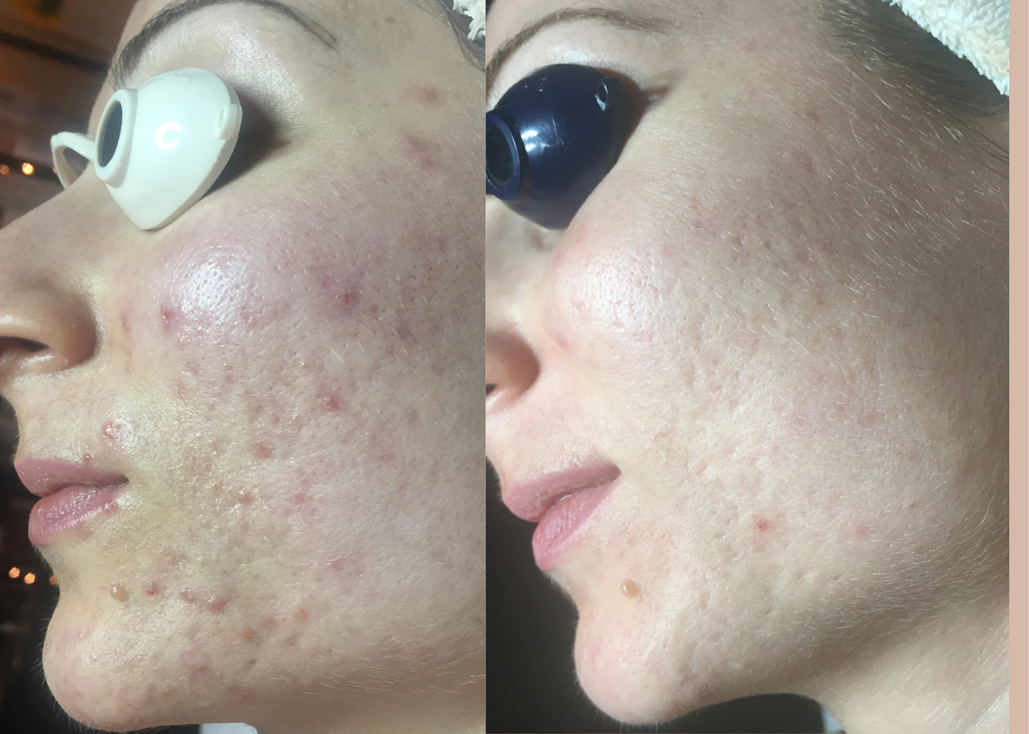 15 SBB - 4 month comprehensive program- Acne Clearing + Scar Removal + Pigment Correction (2)