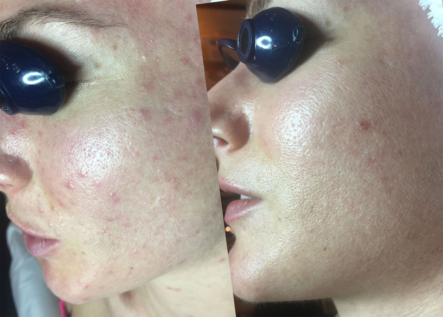 15. Acne Clearing and Redness Relief - 3 acne rescue treatements