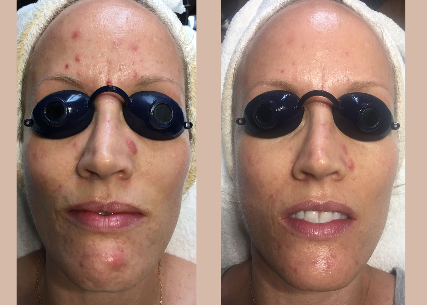 16. Acne Clearing after 1 Chemical Peel