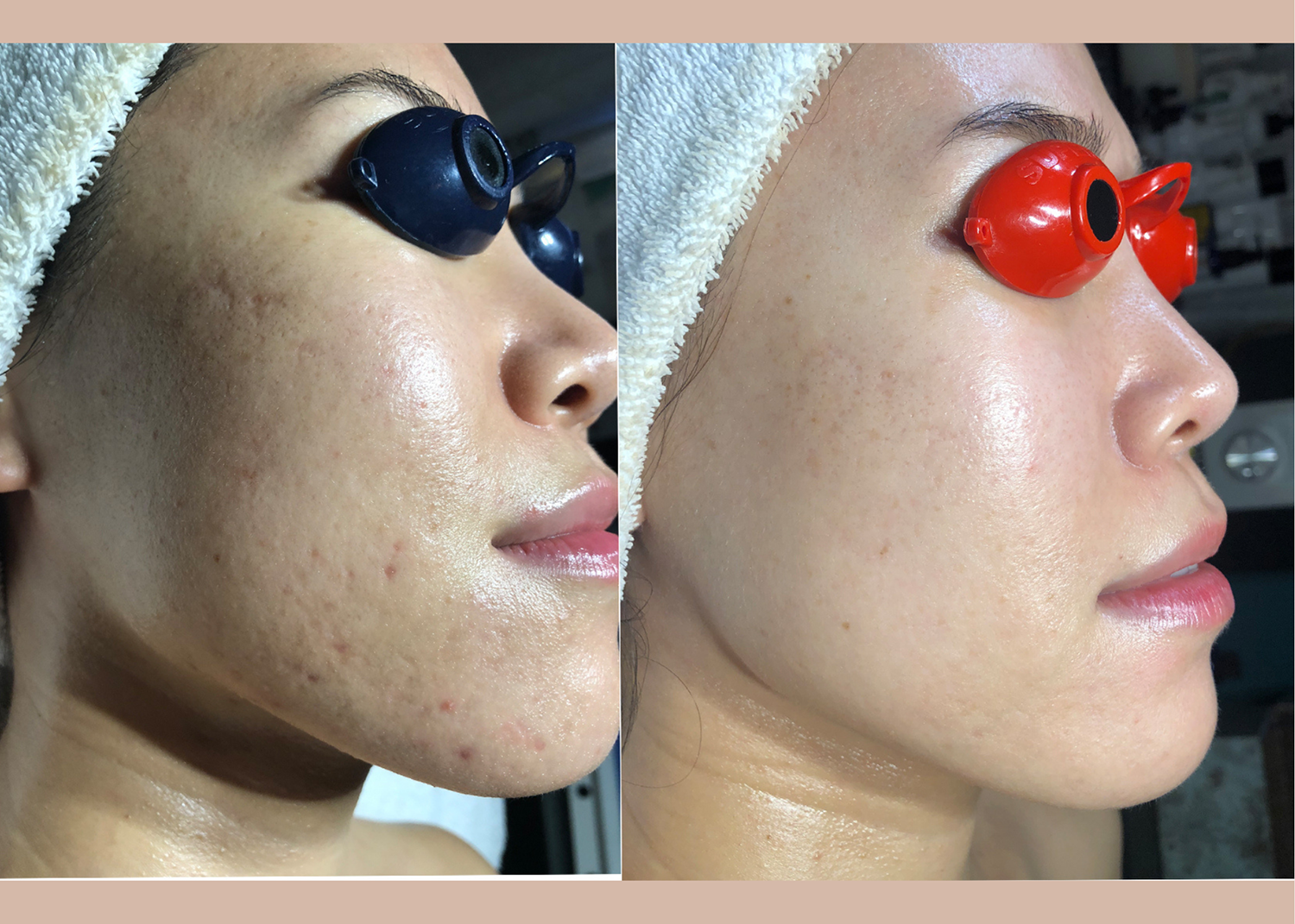 16. SBB- 4 month comprehensive program- Acne Clearing + Scar Removal + Pigment Correction (9)