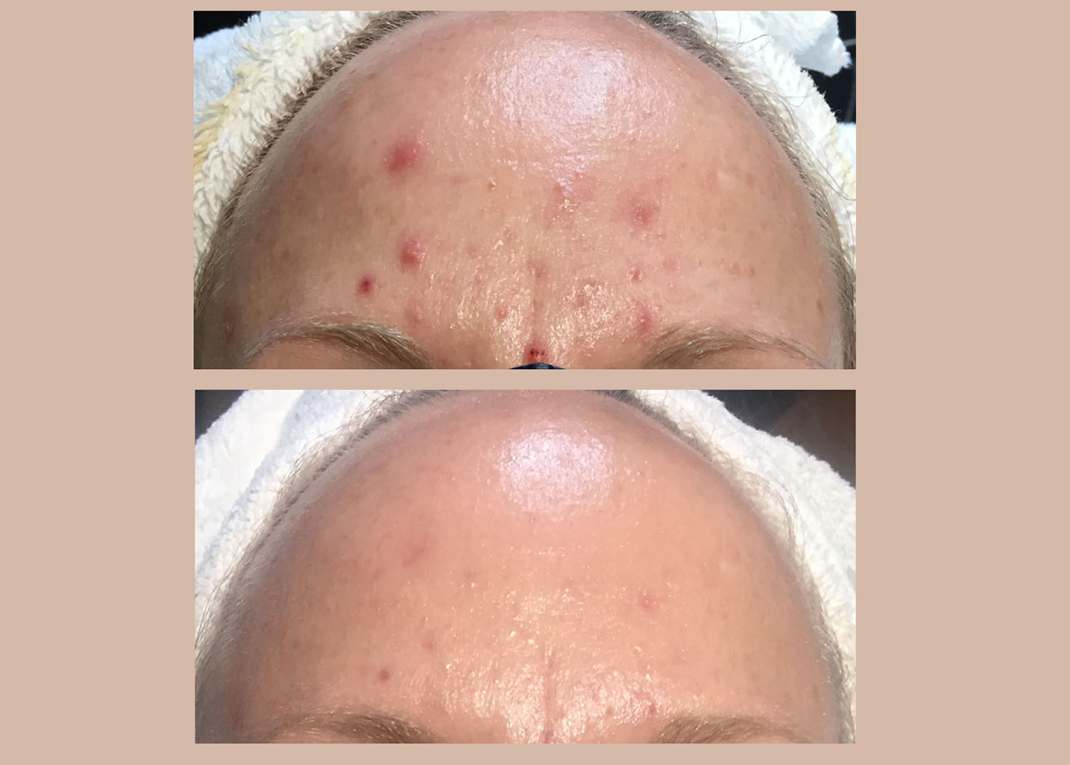 16.1 Acne Clearing + Pigment Control - 1 chemical peels