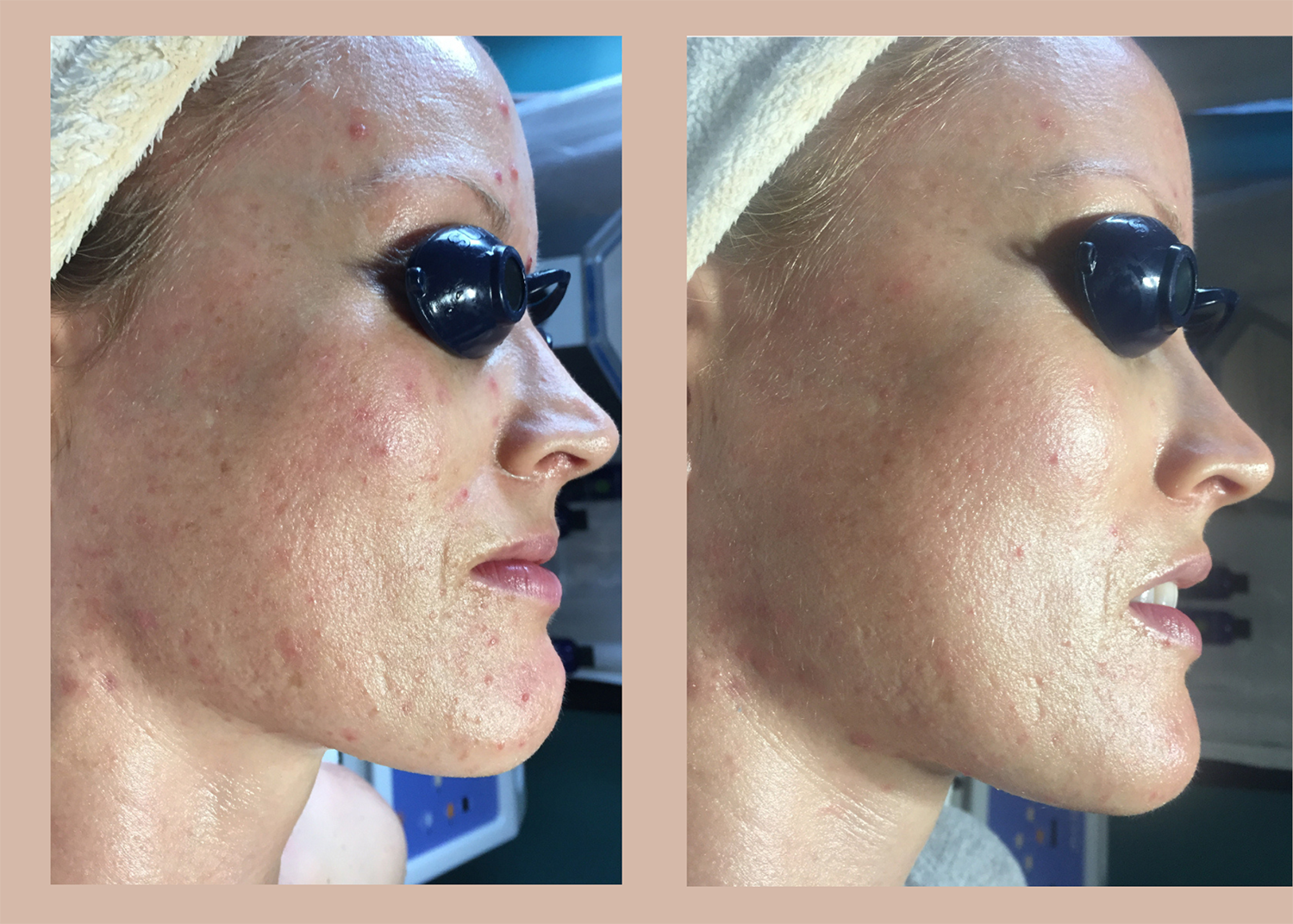 16.2 Acne Clearing after 1 Chemical Peel (2)