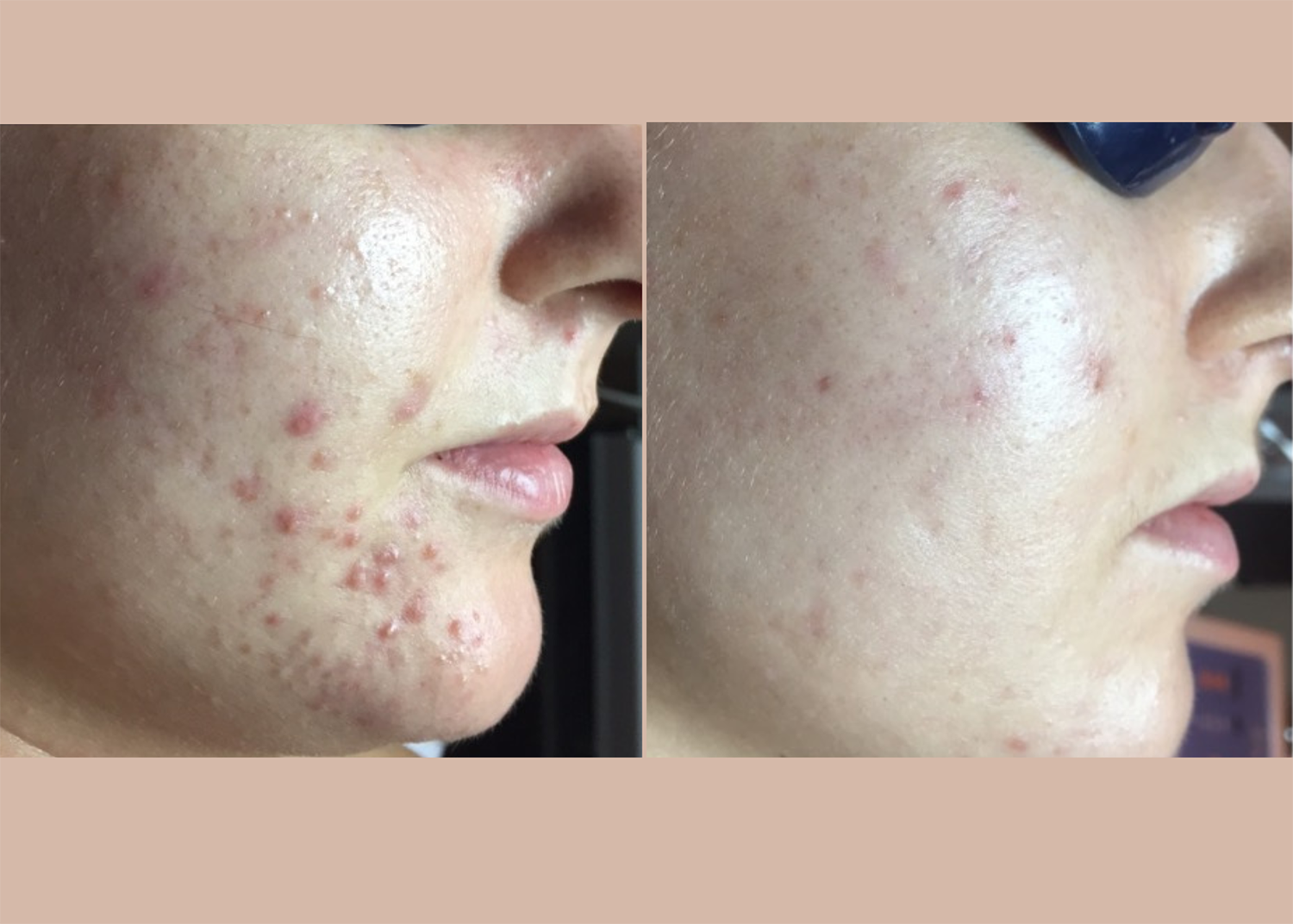 17.2. Acne Clearing after 2 Diamond Glow Facials