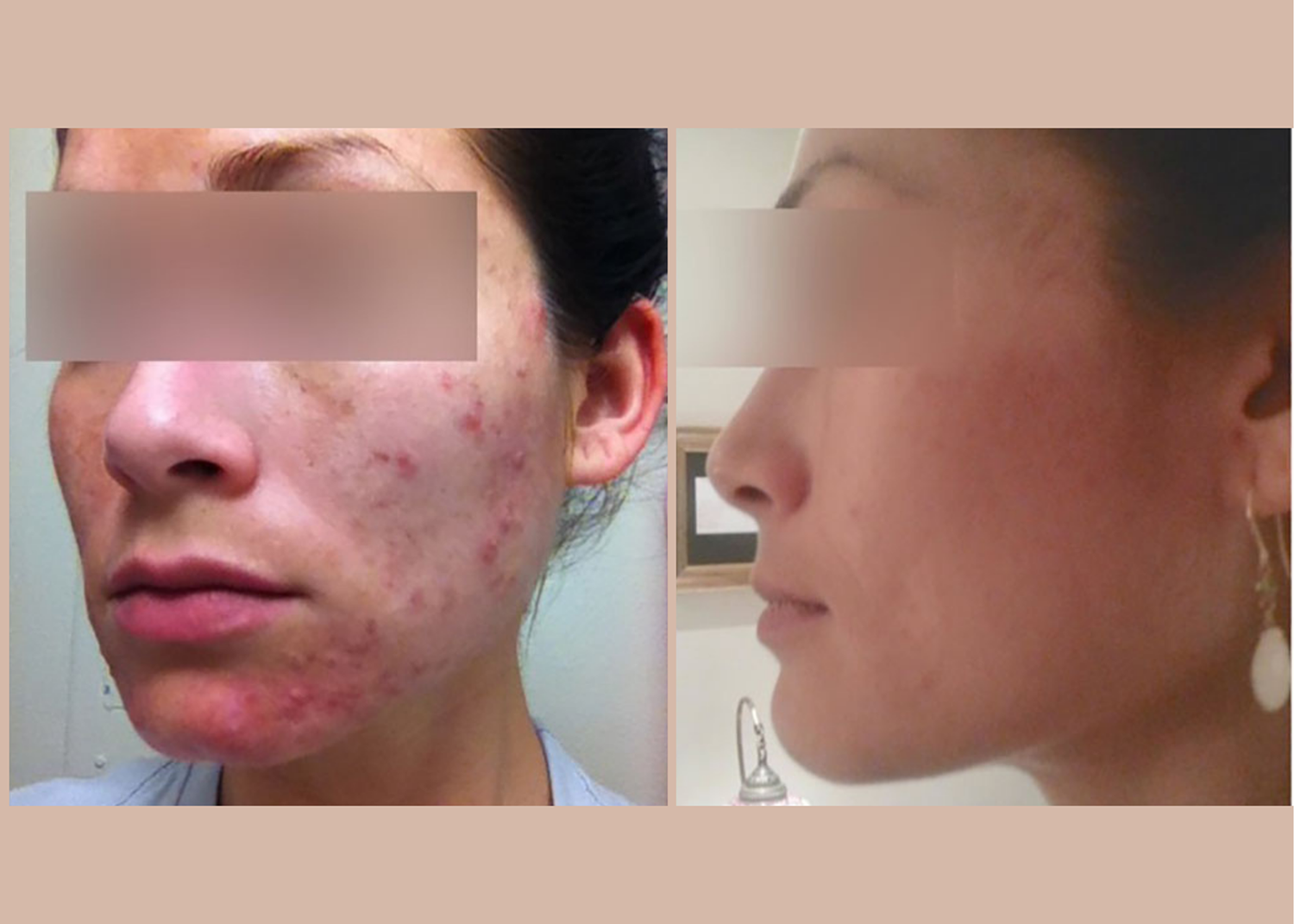 18. SBB- 4 month comprehensive program- Pigment Correction + Acne Clearing (9)