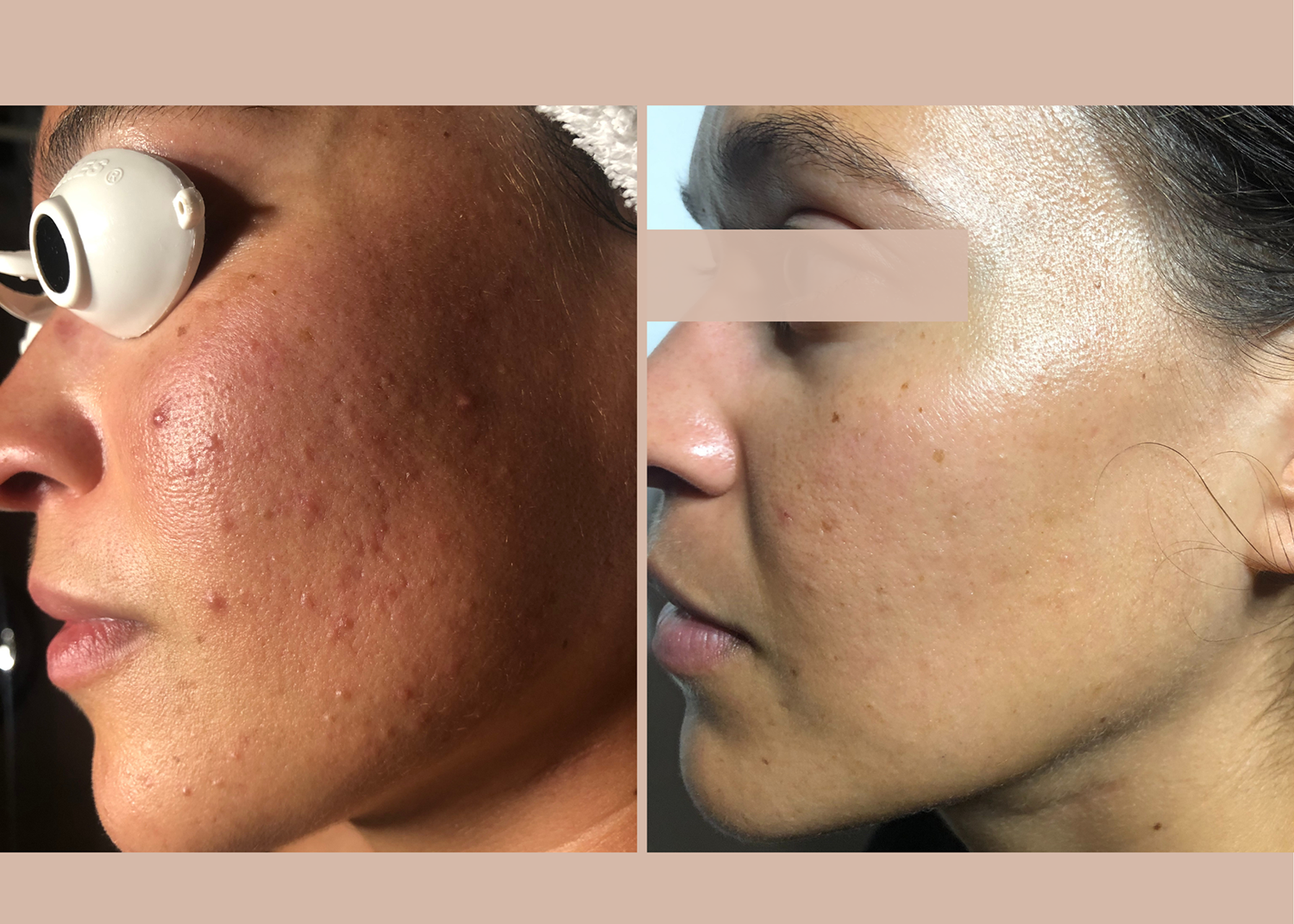 19 SBB- 4 month comprehensive program - Acne Clearing