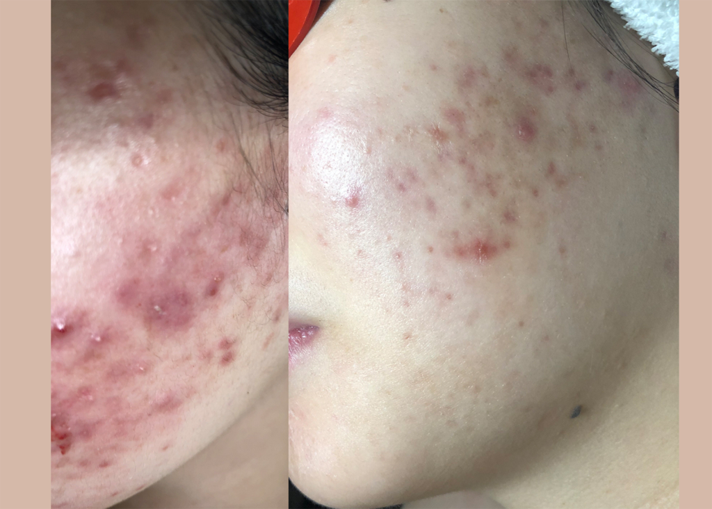 Acne Clearing ad Scarring: 3 Chemical Peelss