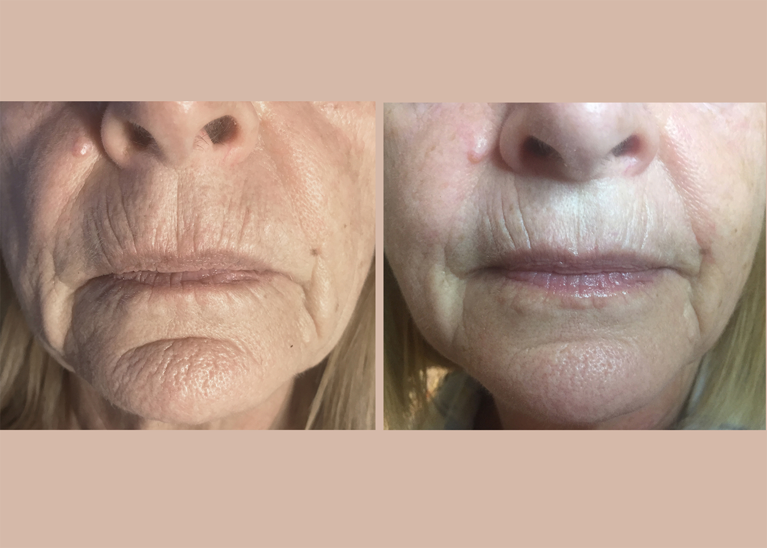 Age Repair: 3 Micro-needling Sessions