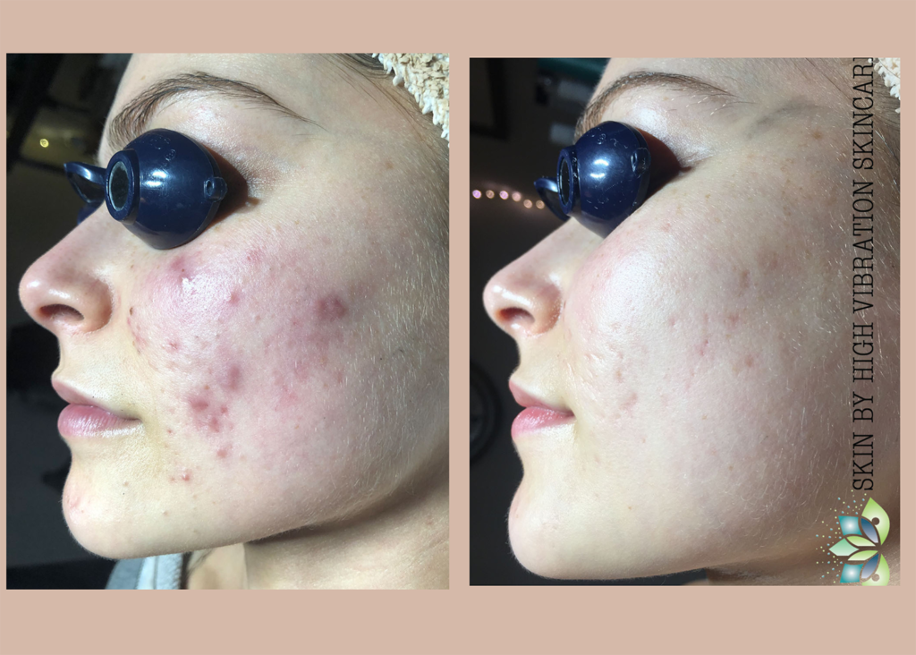 2.1Acne Clearing + Pigment Correction (3 chemical peels ) (3)