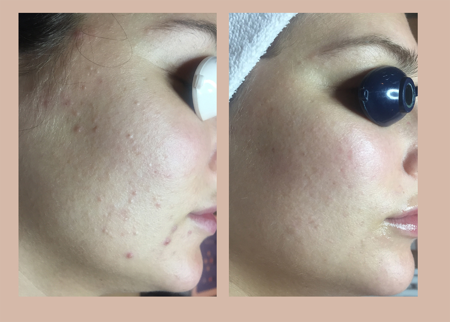 20. Acne Clearing - 2 chemical peels