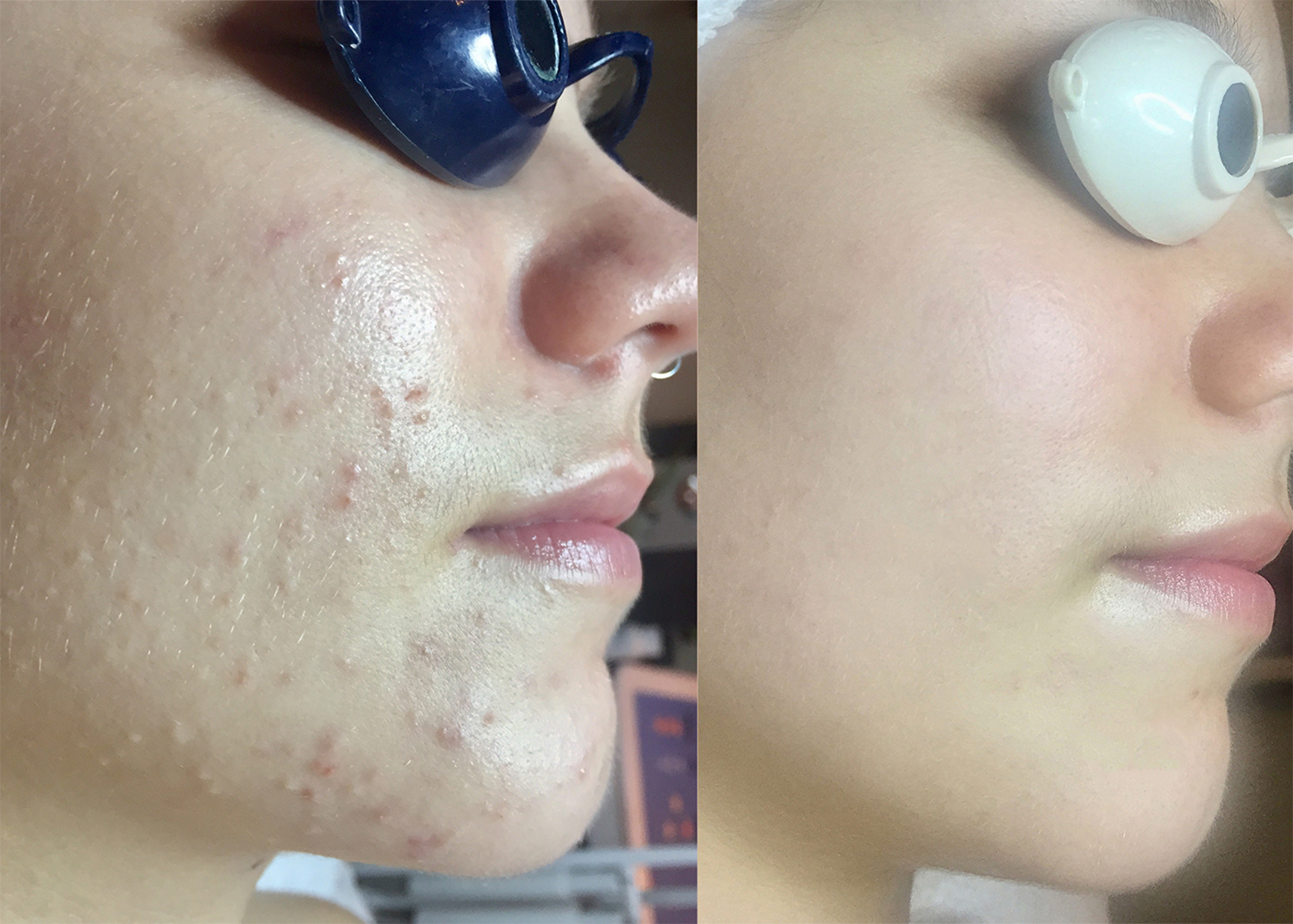 25. Acne Clearing 1 Chemical Peel