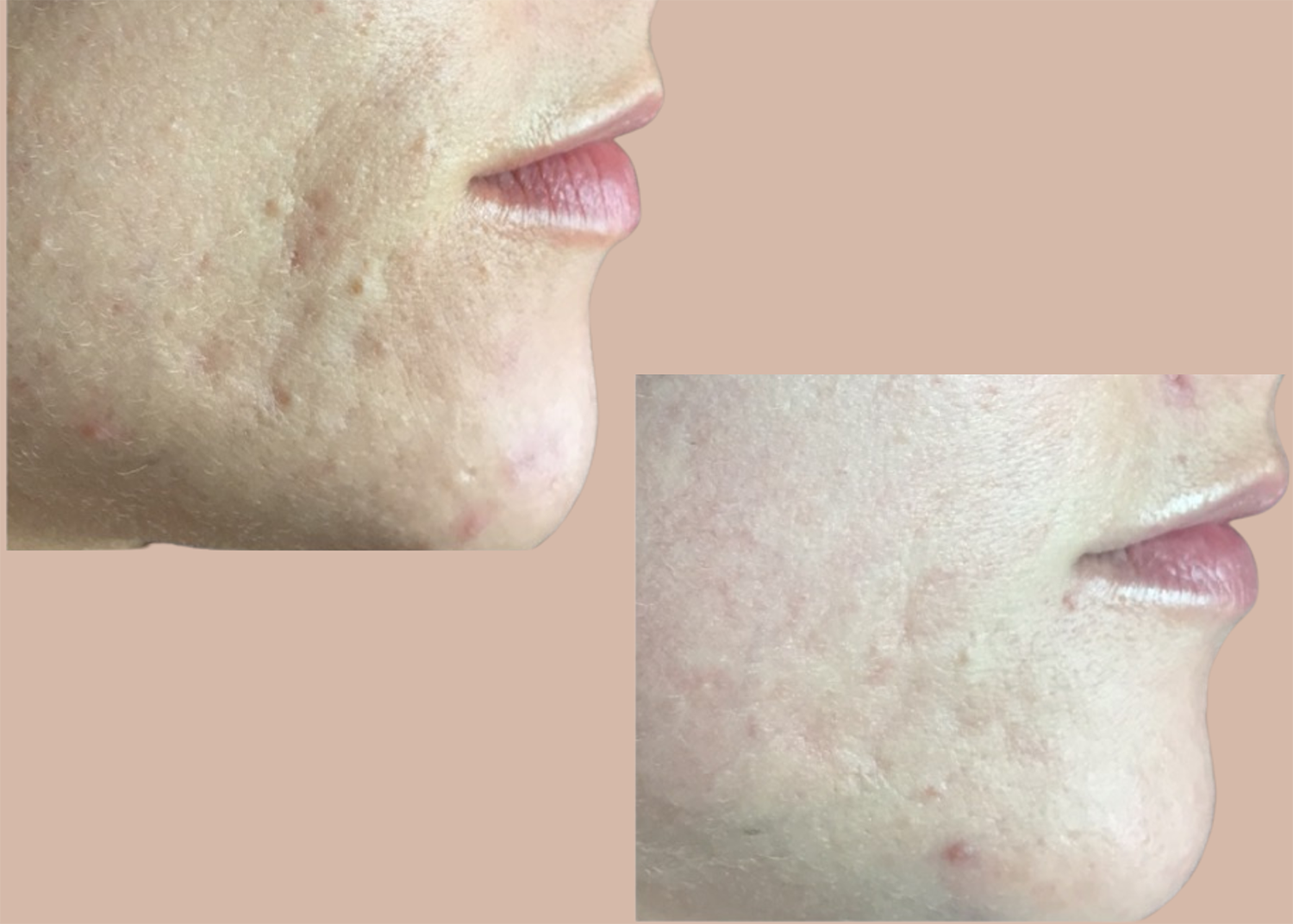 26. Acne Clearing + Scar Repair - 2 chemical peels