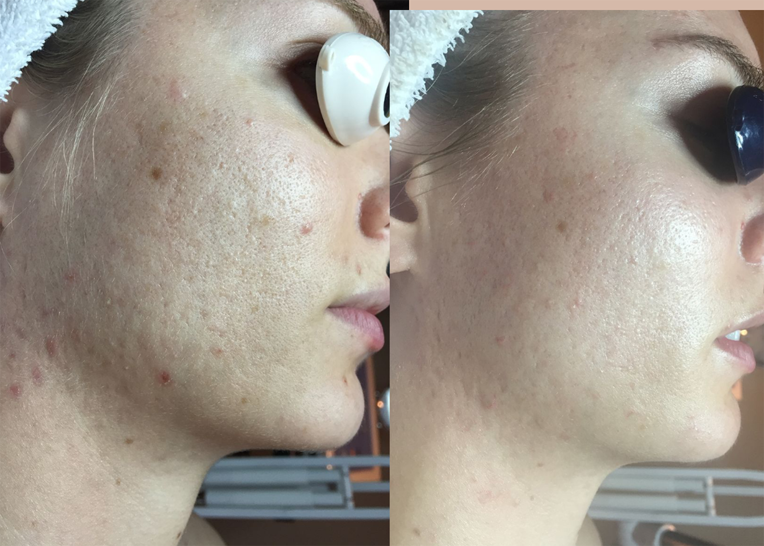 27. Acne Clearing + Texture - 1 chemical peel