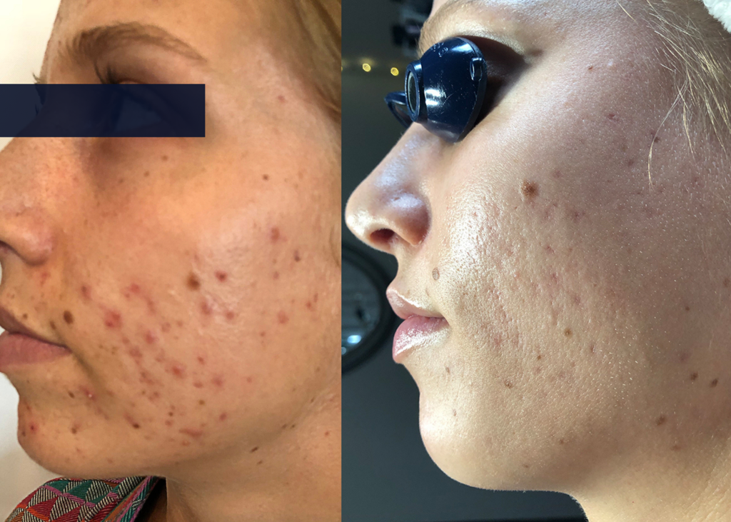 4.1 SBB 4 month comprehensive program- Acne Clearing + Pigment Correction (8)