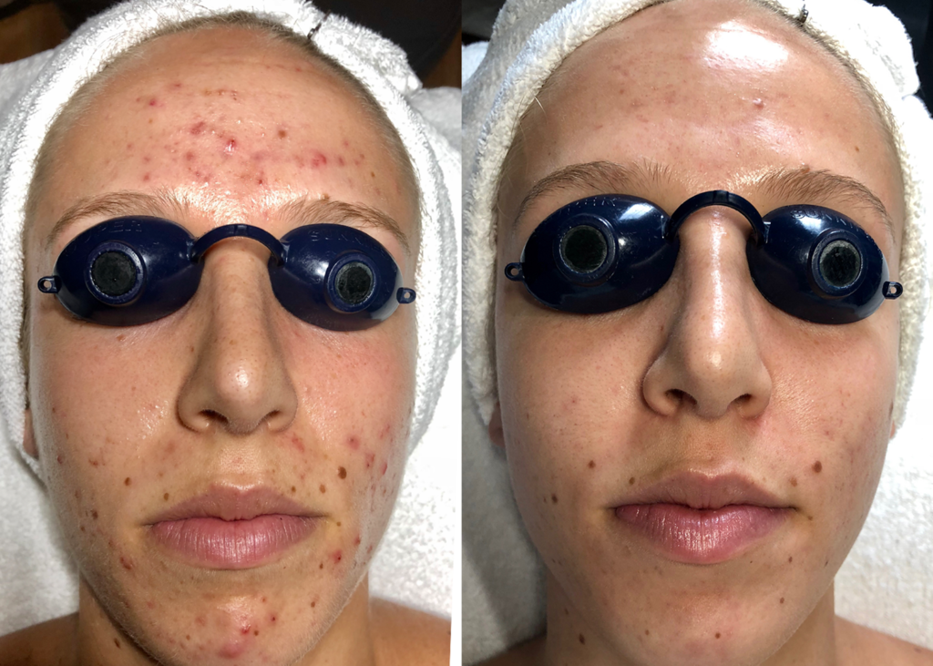 Acne Clearing: 4 month Series of Diamond Glow + Chemical Peels