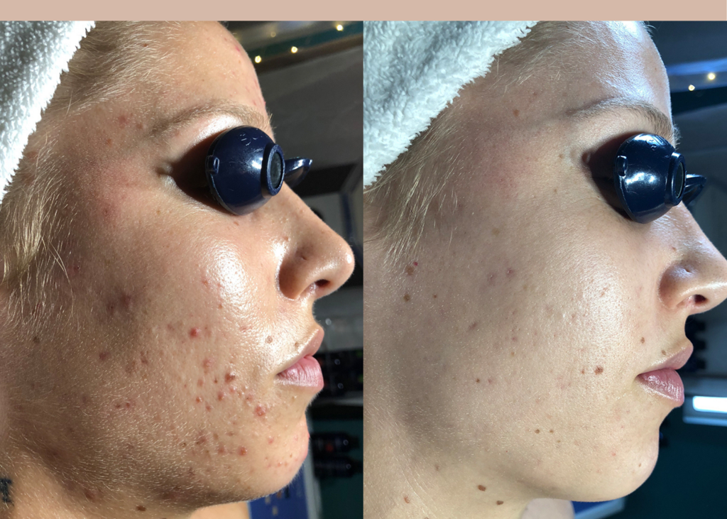 Acne Clearing: 4 month Series of Diamond Glow + Chemical Peels