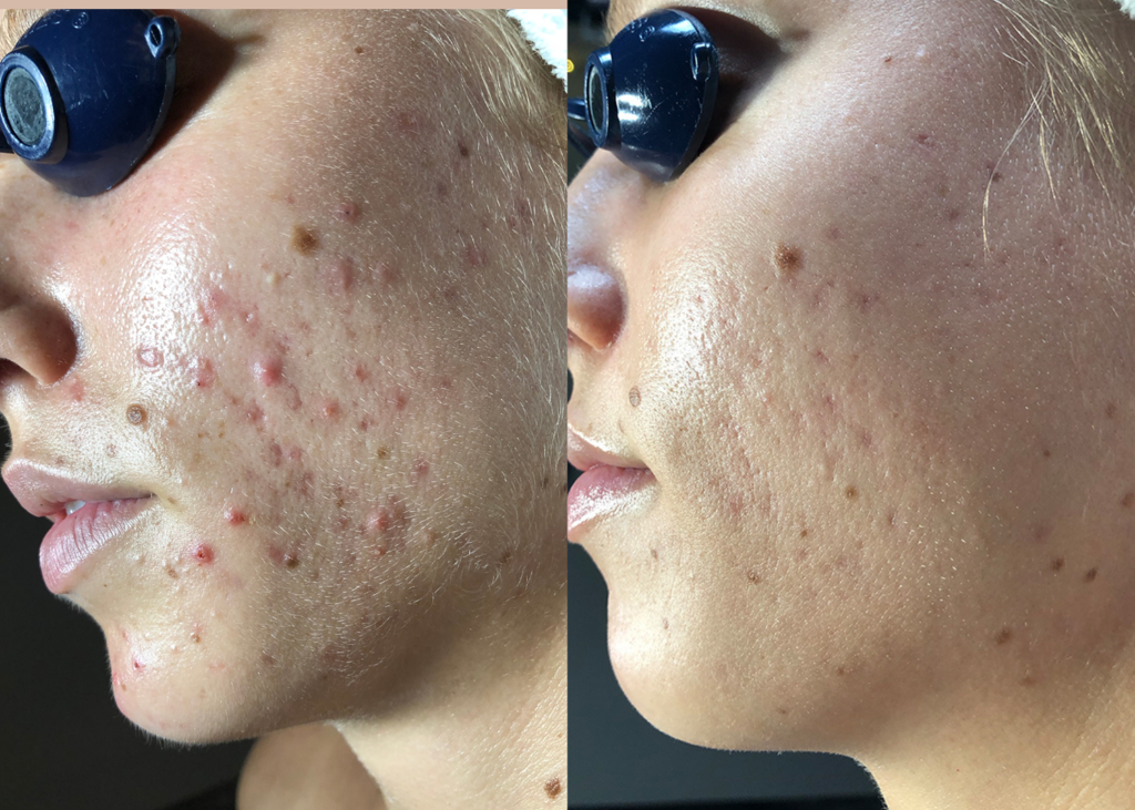 4.6 SBB- 4 month comprehensive program- Acne Clearing + Pigment Correction (6)