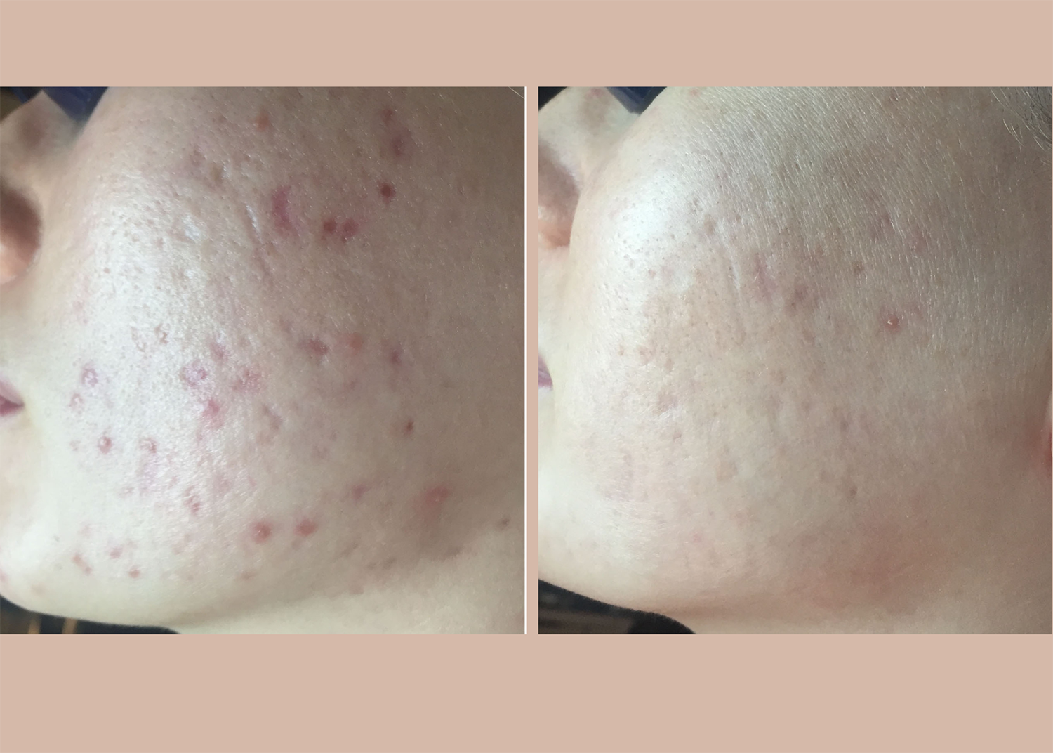 6. 1 Acne Clearing + Scar Removal