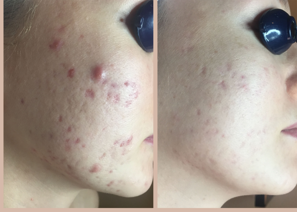 6. Acne Clearing + Scar Removal (2)