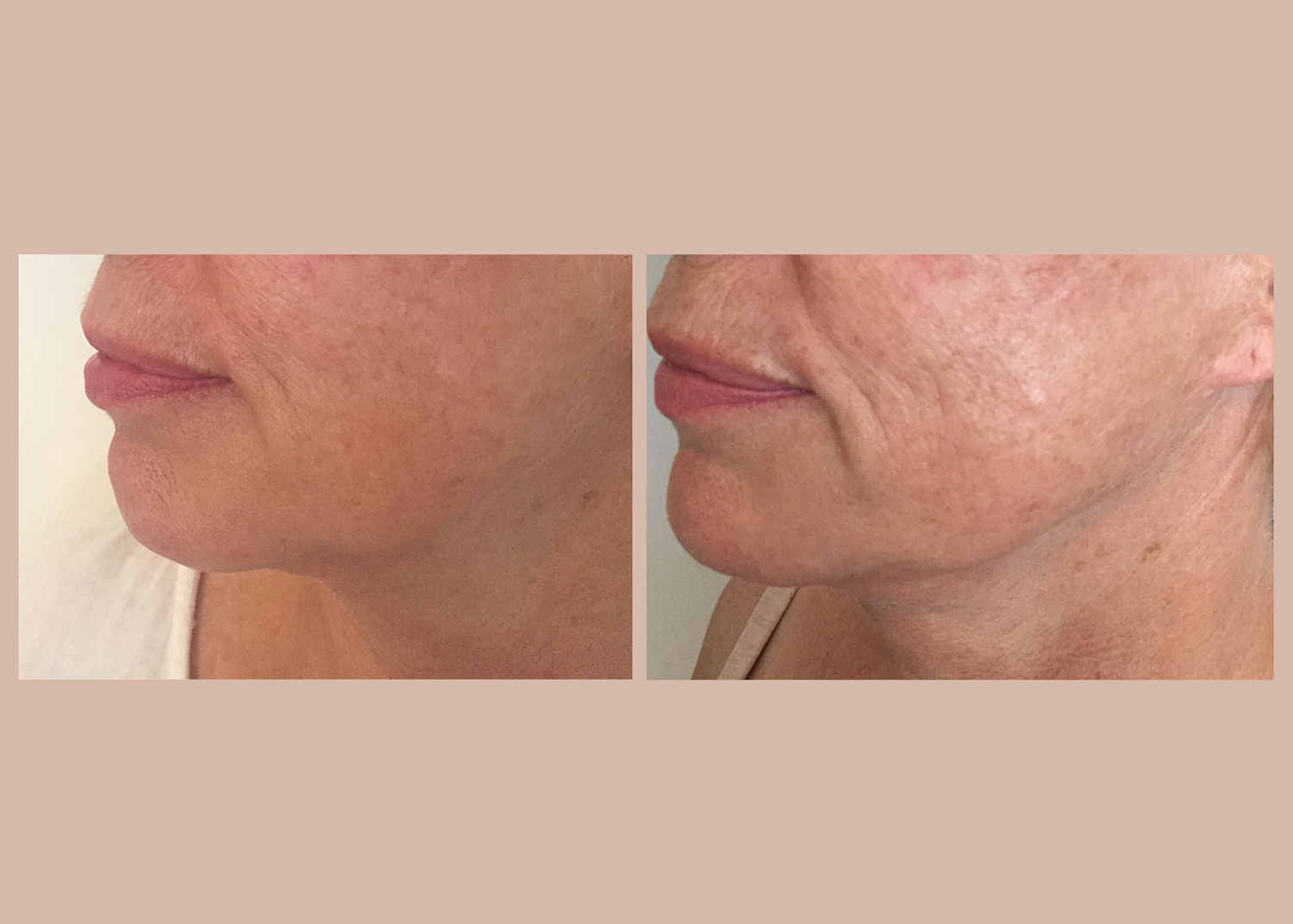 Age Repair: 3 Micro-needling Sessions