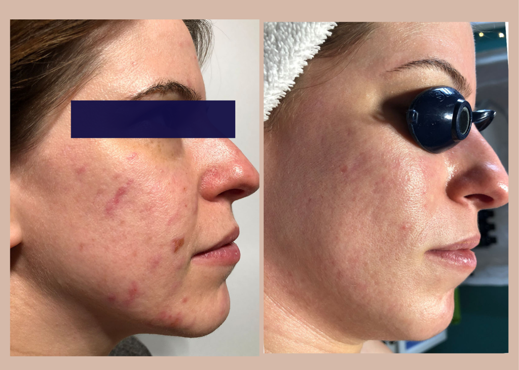 6. SBB- 4 month comprehensive program- Acne Clearing + Scar Removal + Pigment Correction (3)