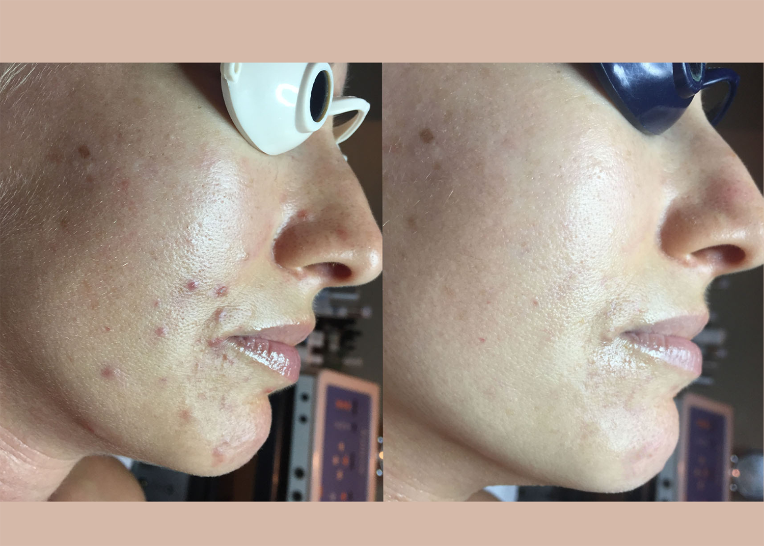 7. Acne Clearing 2 Diamond Glow + Chemical Peel Boost