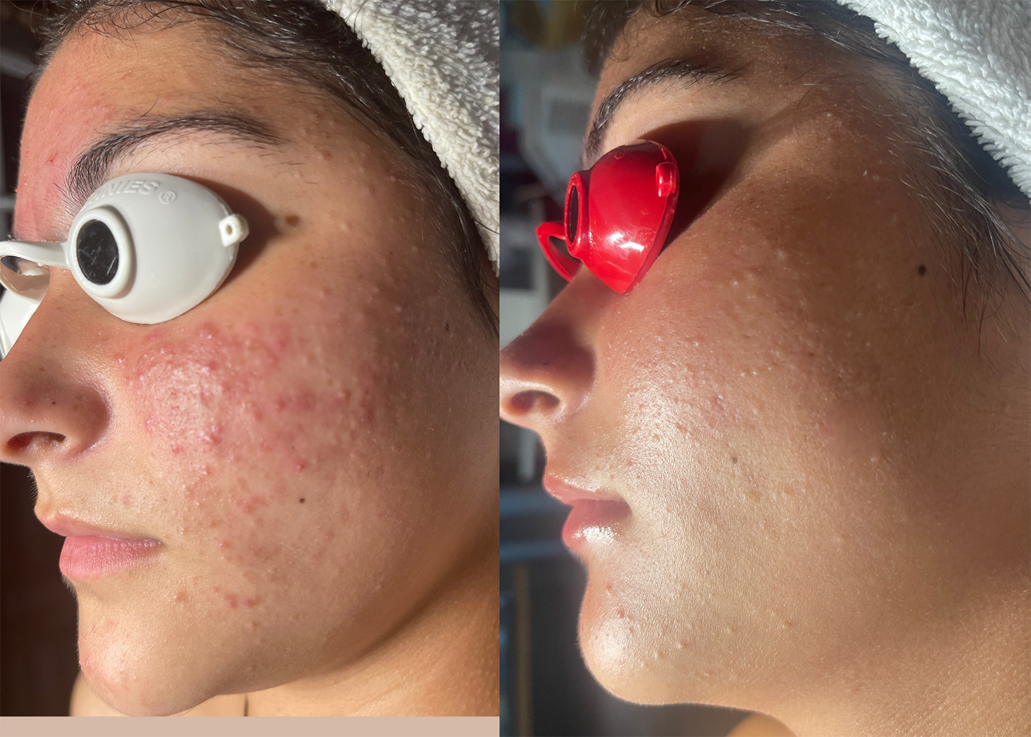 7.1. Acne Clearing - 6 Diamond GLow + BLUE Light + 3 Chemical Peel Boost +