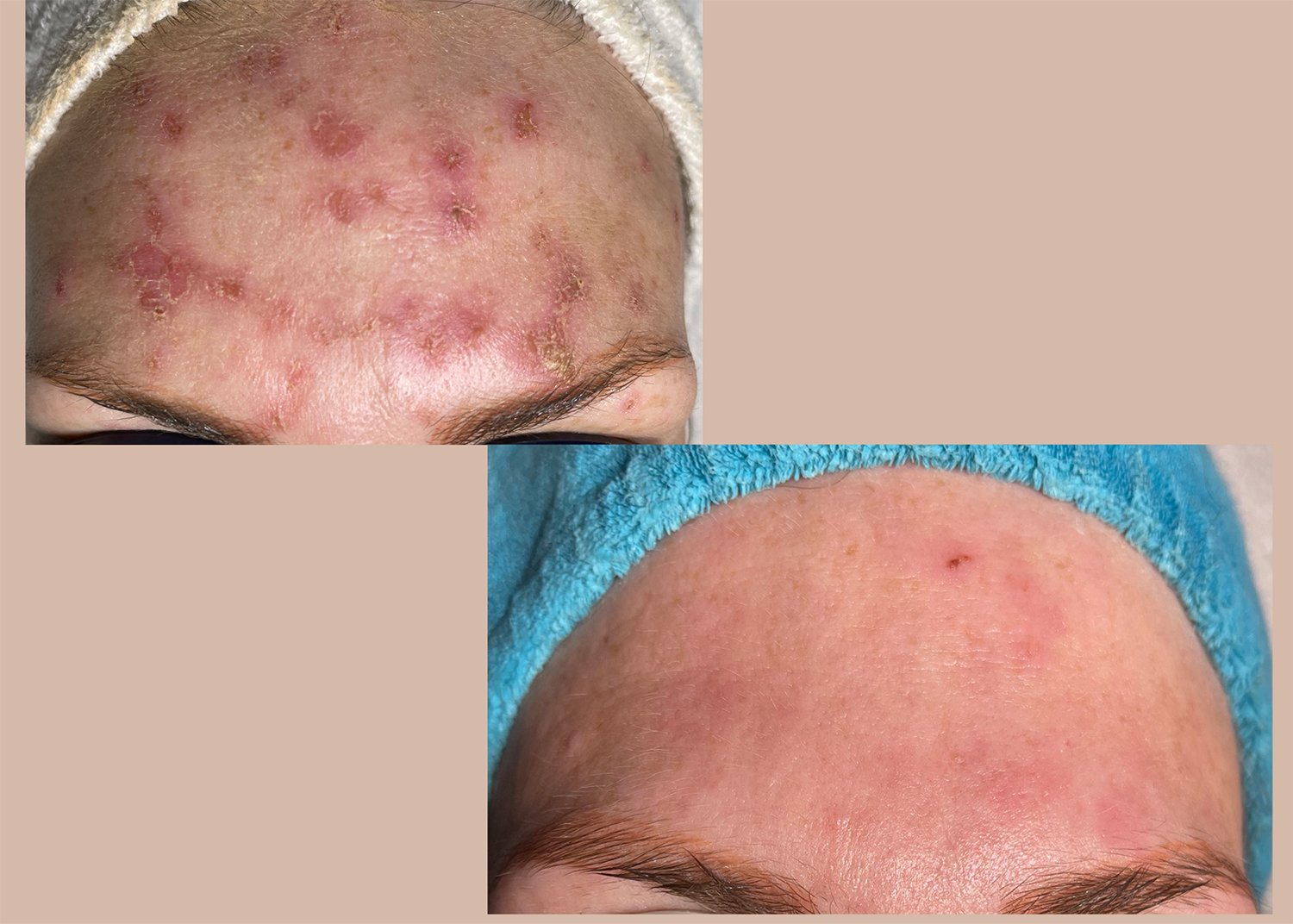 8. Wound Repair + Pigment Correcting 3 Collagen Boost Facials + targeted skincare