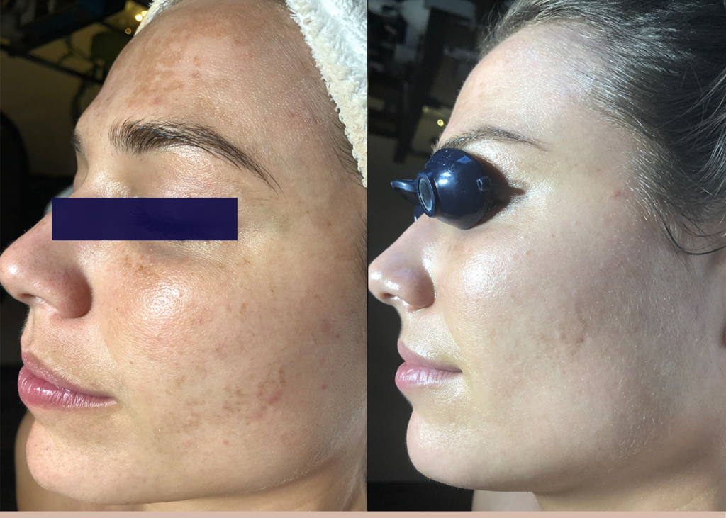 9 SBB- 4 month comprehensive program- Pigment Correction (2)